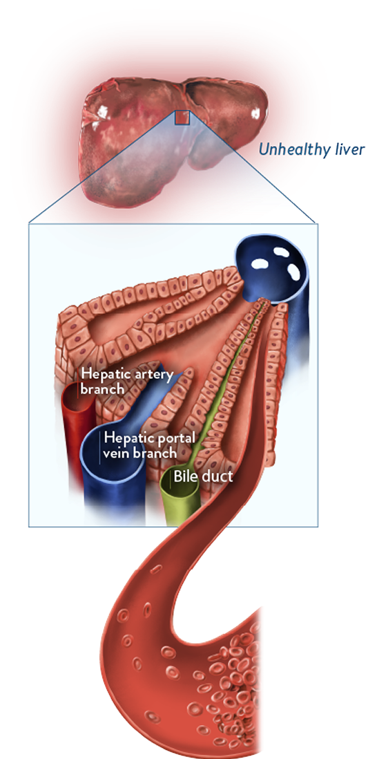 unhealthy liver cutout view